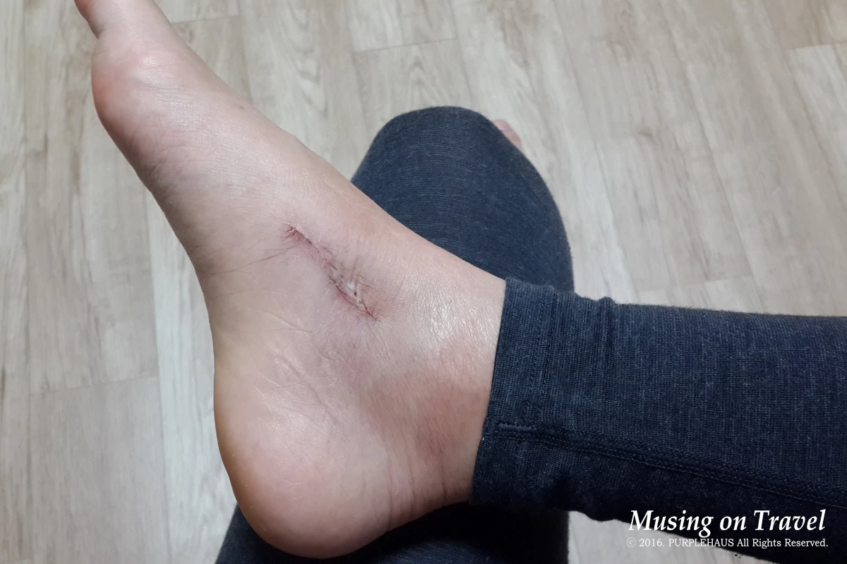 부주상골 제거 수술 후 첫 외래 진료 시 깁스 제거